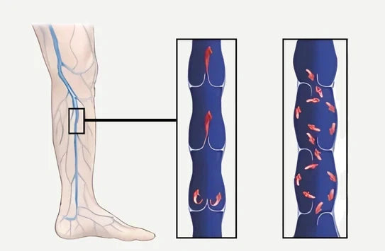 Nextpair | Medicinske lårhøje kompressionsstrømper med åben tå (34–46 mmHg)