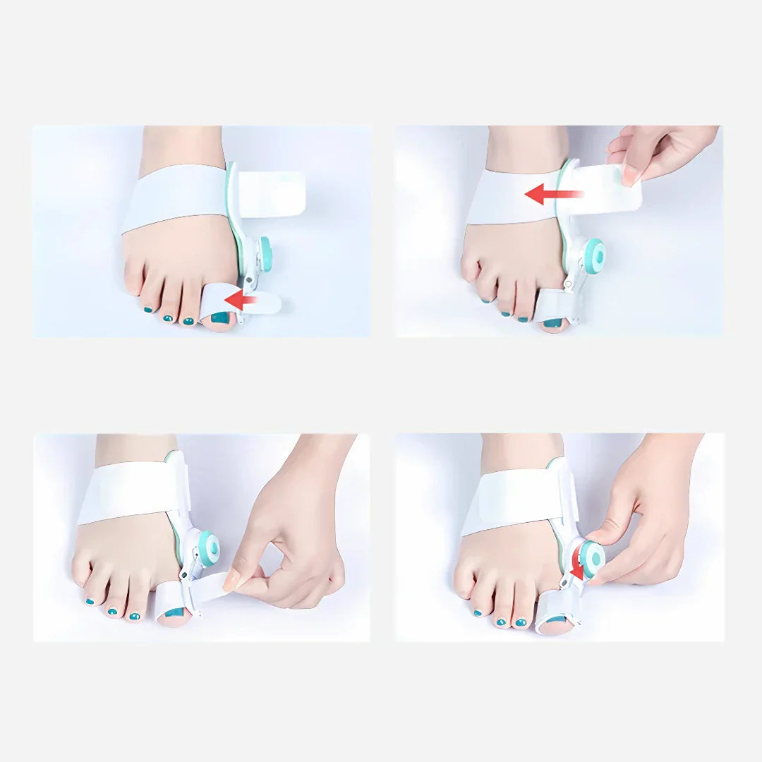 Nextpair | Justerbar tåkorrektor til hallux valgus og bunion korrektion
