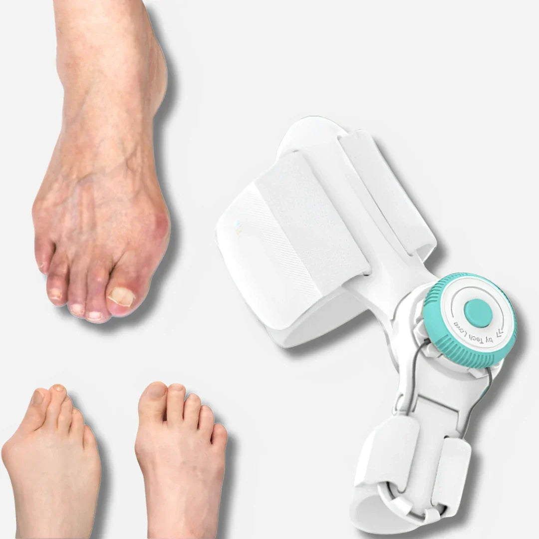 Nextpair | Justerbar tåkorrektor til hallux valgus og bunion korrektion
